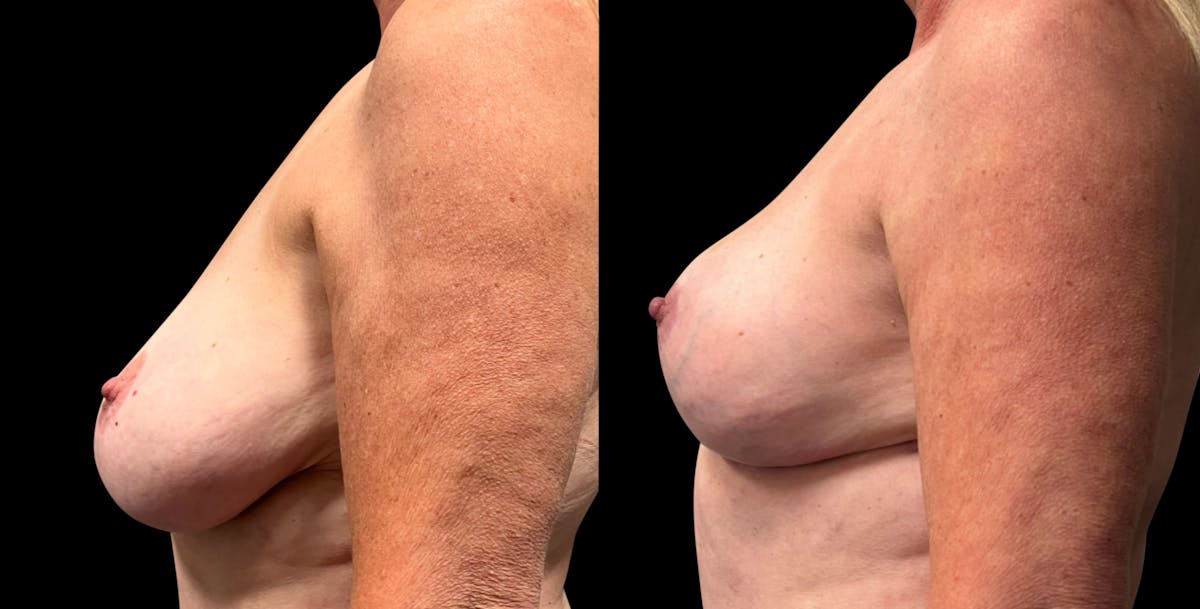 Breast Reduction Before & After Gallery - Patient 799702 - Image 3