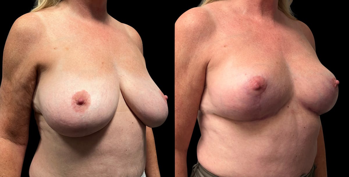 Breast Reduction Before & After Gallery - Patient 799702 - Image 4