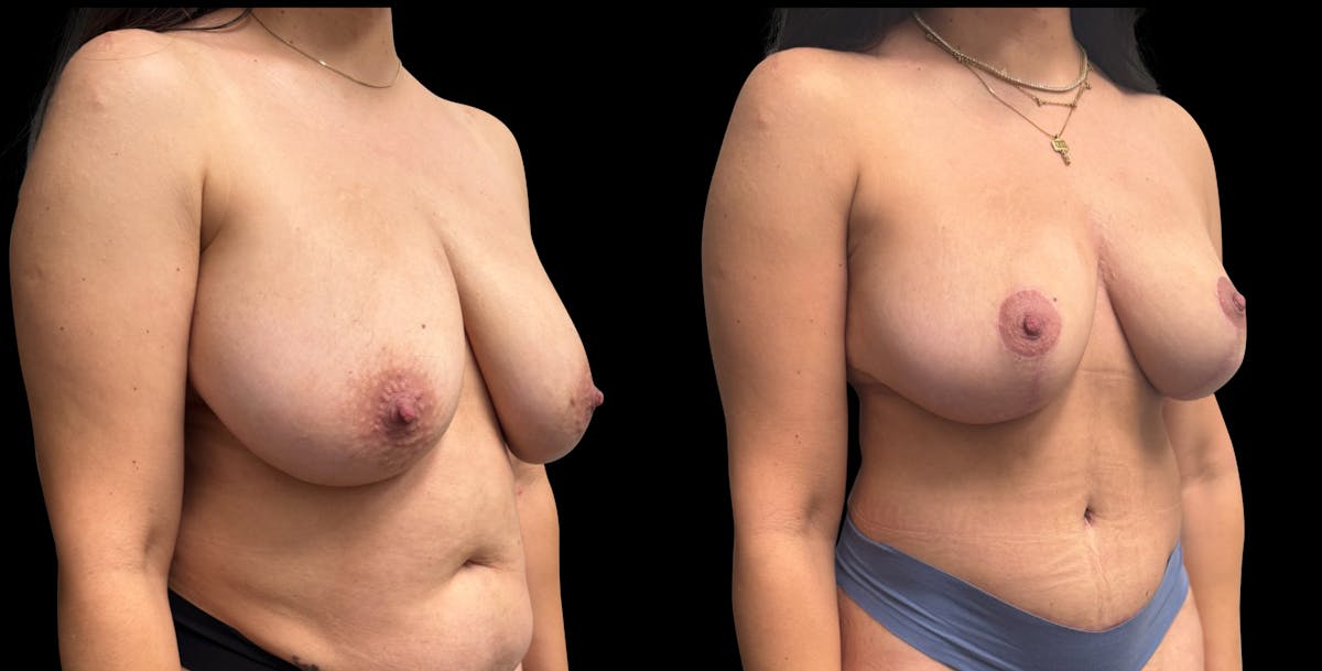 Breast Reduction Before & After Gallery - Patient 734525 - Image 2