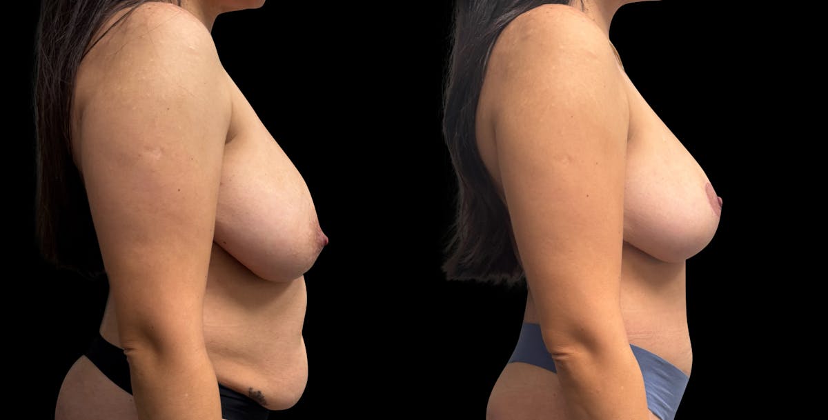 Breast Reduction Before & After Gallery - Patient 734525 - Image 3