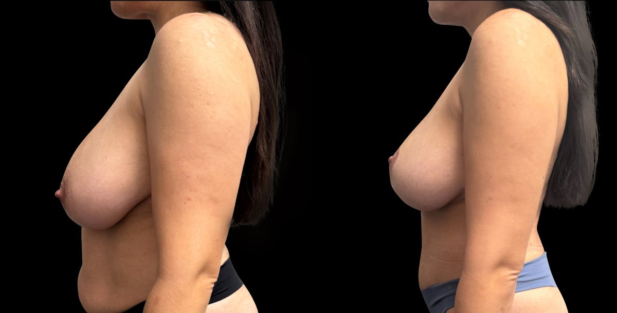 Breast Reduction Before & After Gallery - Patient 734525 - Image 5