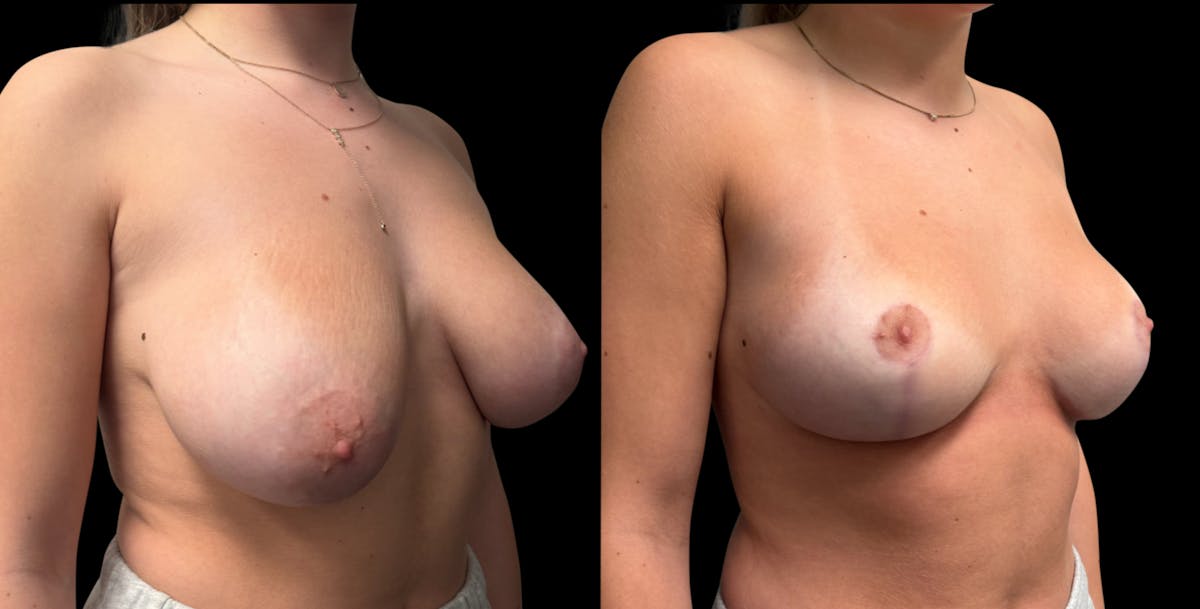 Breast Reduction Before & After Gallery - Patient 286054 - Image 3