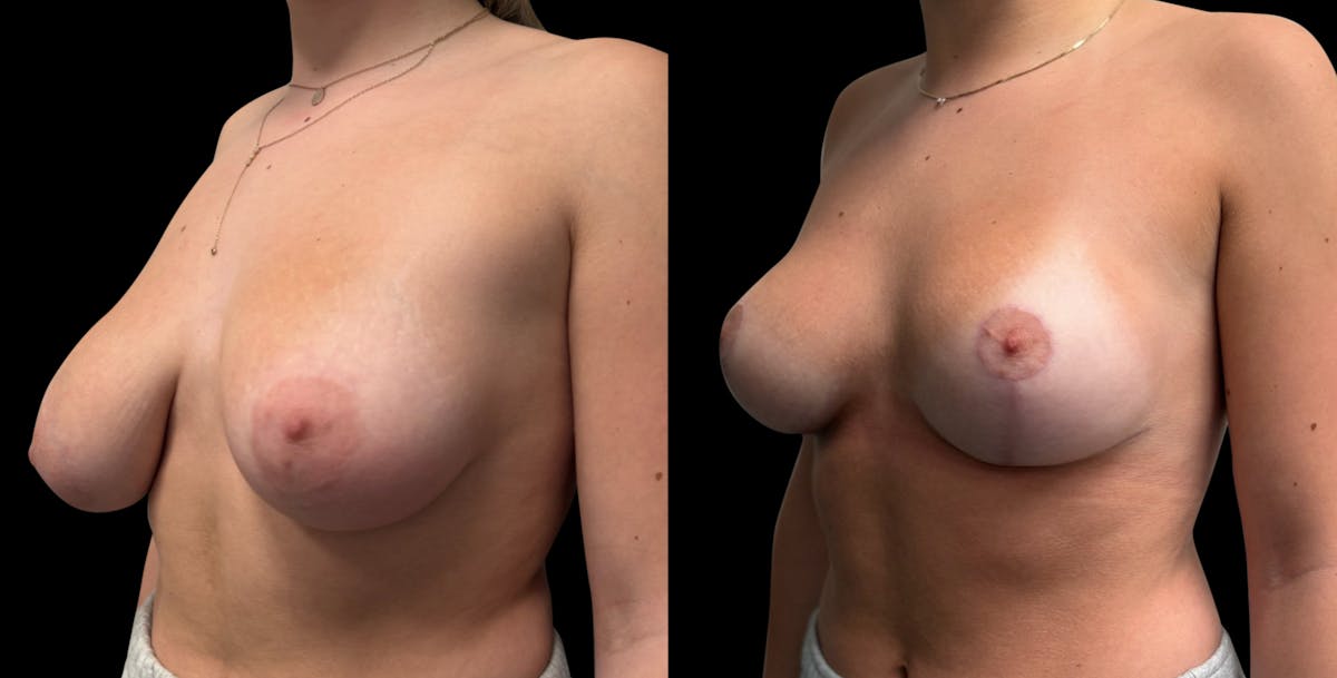 Breast Reduction Before & After Gallery - Patient 286054 - Image 2