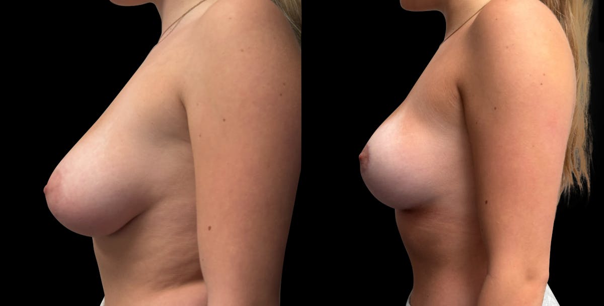 Breast Reduction Before & After Gallery - Patient 286054 - Image 4
