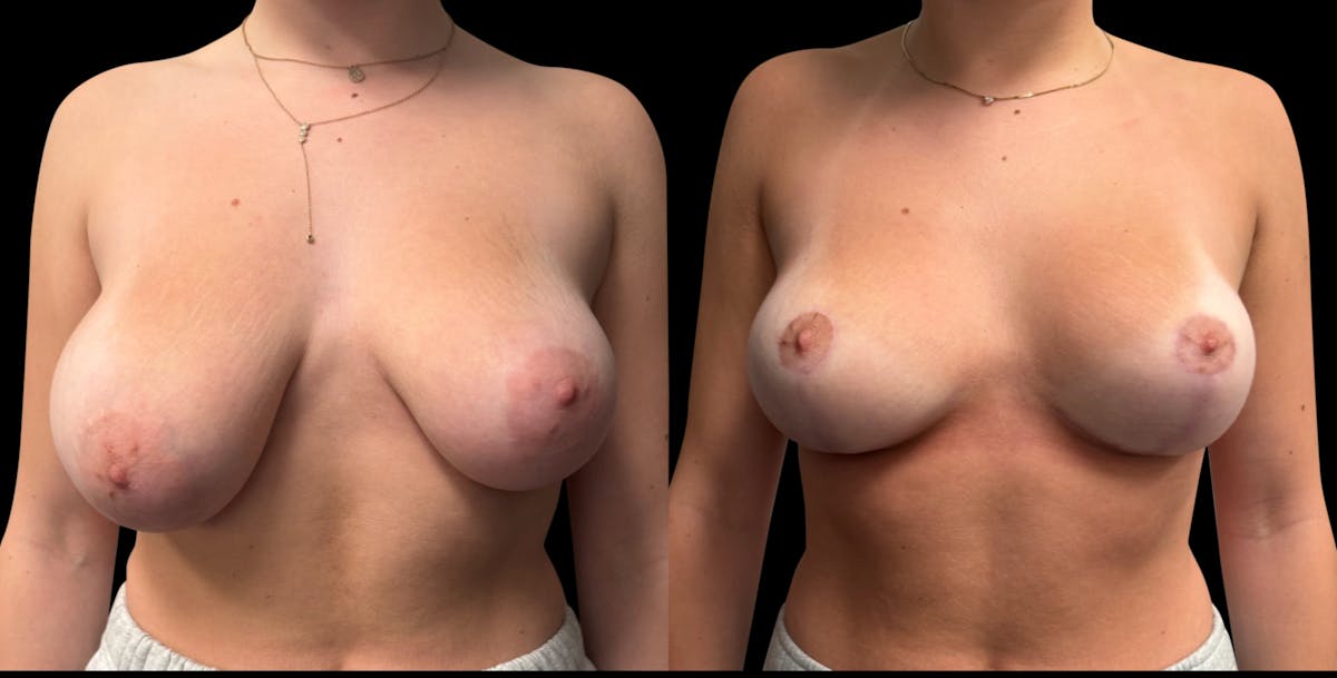 Breast Reduction Before & After Gallery - Patient 286054 - Image 1
