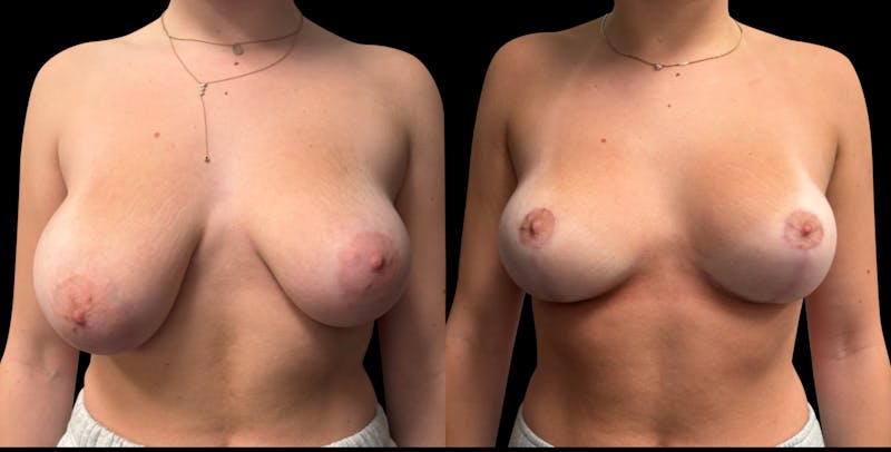 Breast Reduction Before & After Gallery - Patient 286054 - Image 1