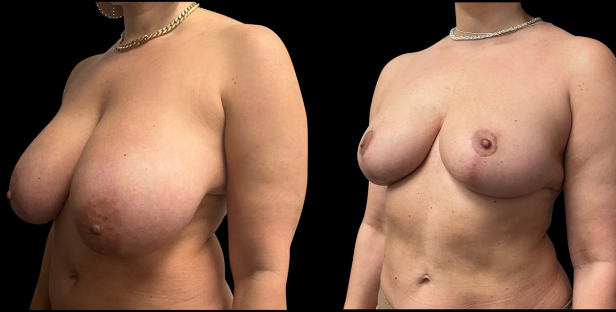 Breast Reduction Before & After Gallery - Patient 546788 - Image 2