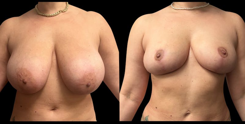 Breast Reduction Before & After Gallery - Patient 546788 - Image 1