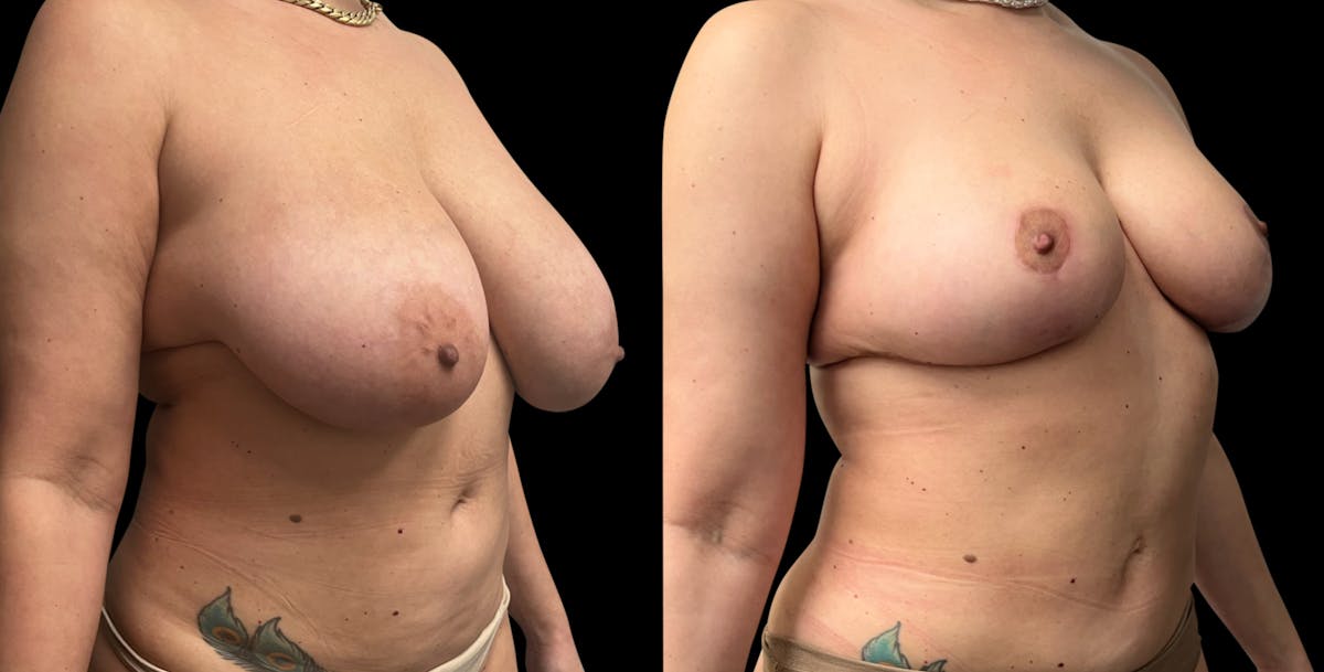 Breast Reduction Before & After Gallery - Patient 546788 - Image 4