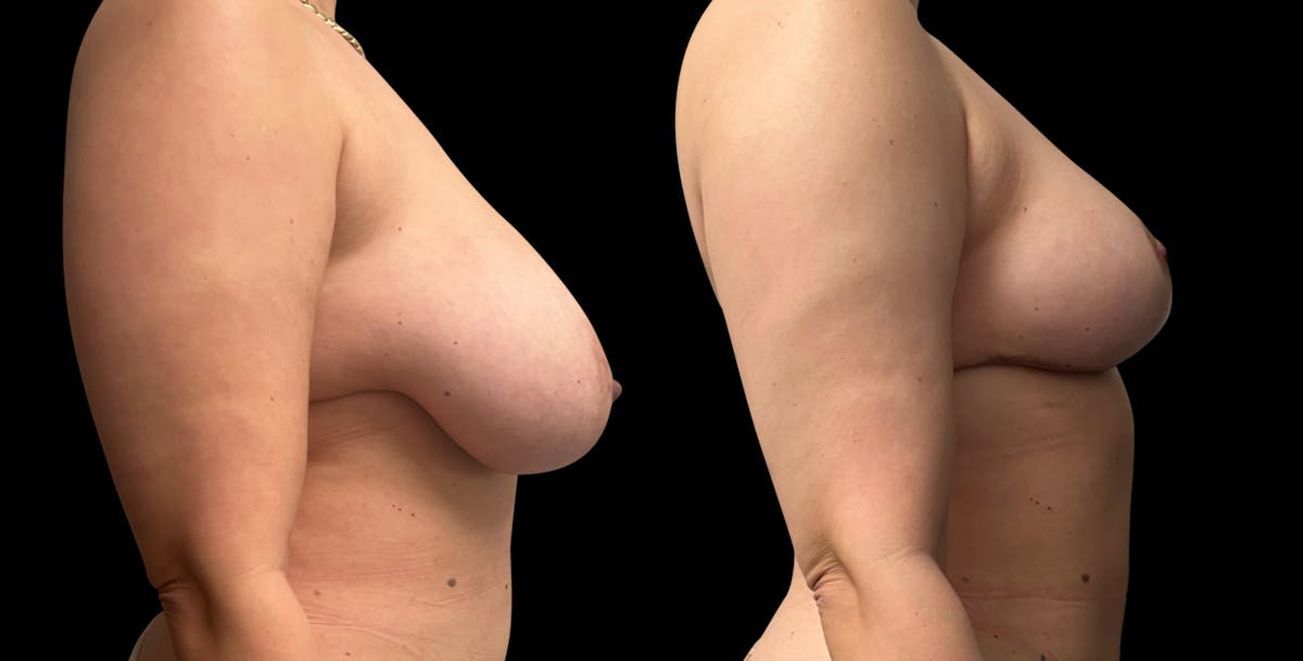 Breast Reduction Before & After Gallery - Patient 546788 - Image 5