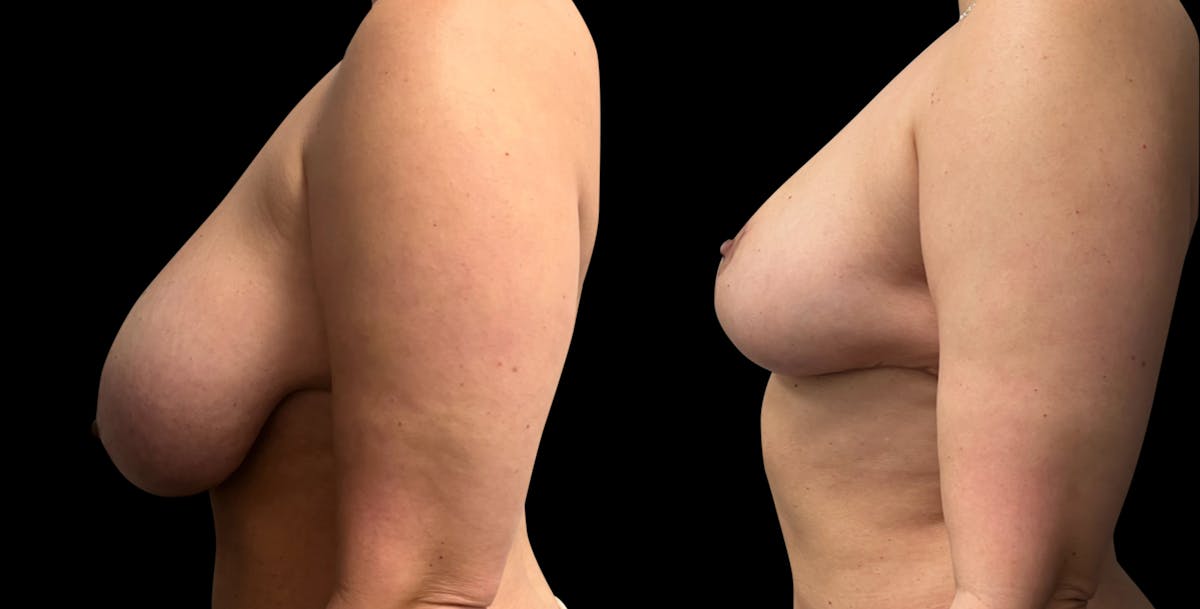 Breast Reduction Before & After Gallery - Patient 546788 - Image 3