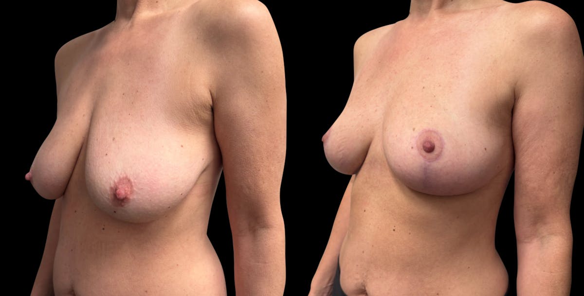 Breast Reduction Before & After Gallery - Patient 289398 - Image 2