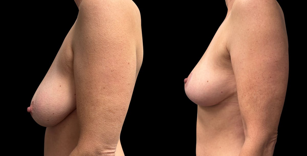 Breast Reduction Before & After Gallery - Patient 289398 - Image 3