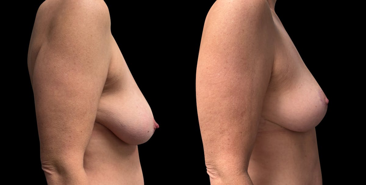 Breast Reduction Before & After Gallery - Patient 289398 - Image 4