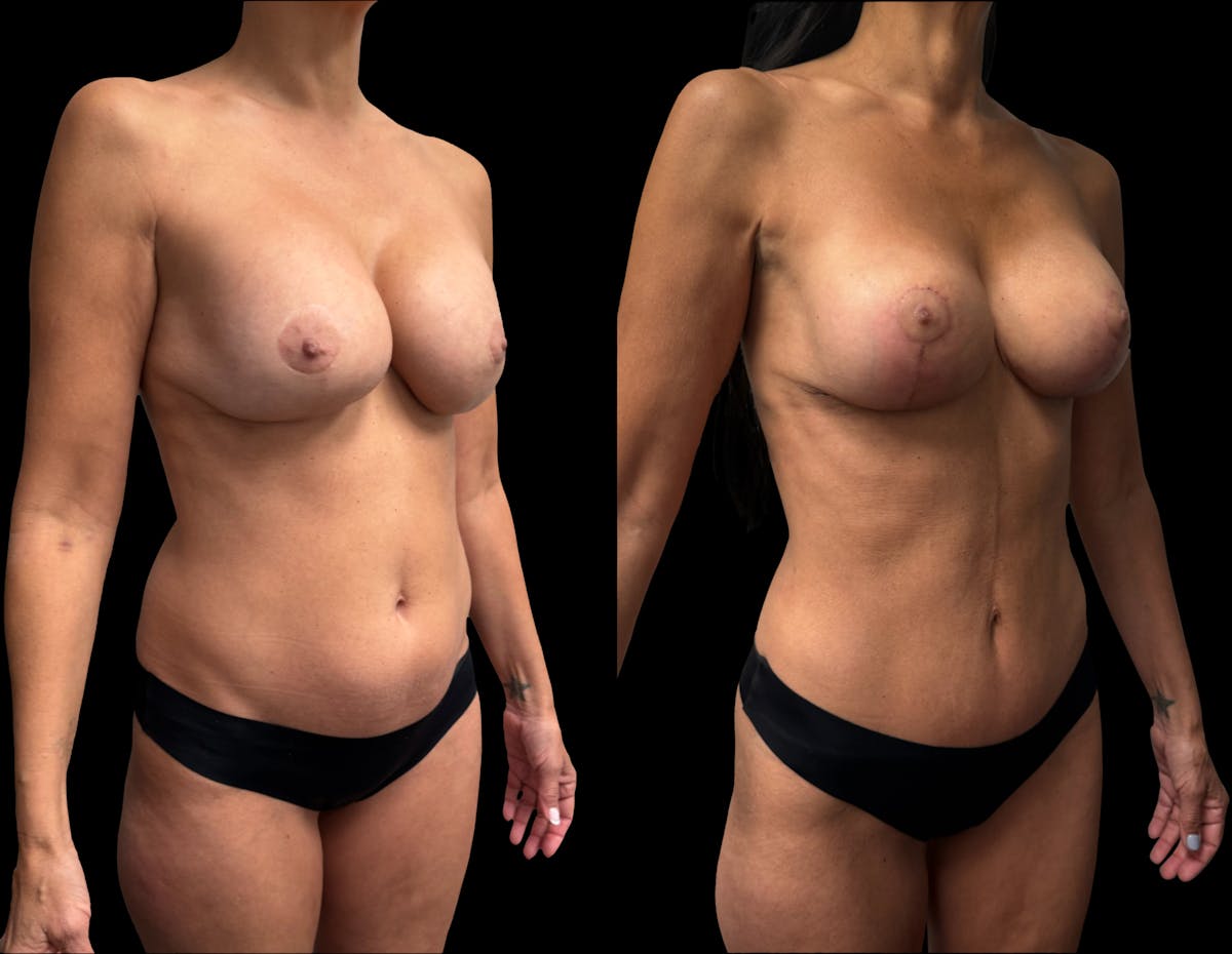 Mommy Makeover Before & After Gallery - Patient 136524 - Image 4