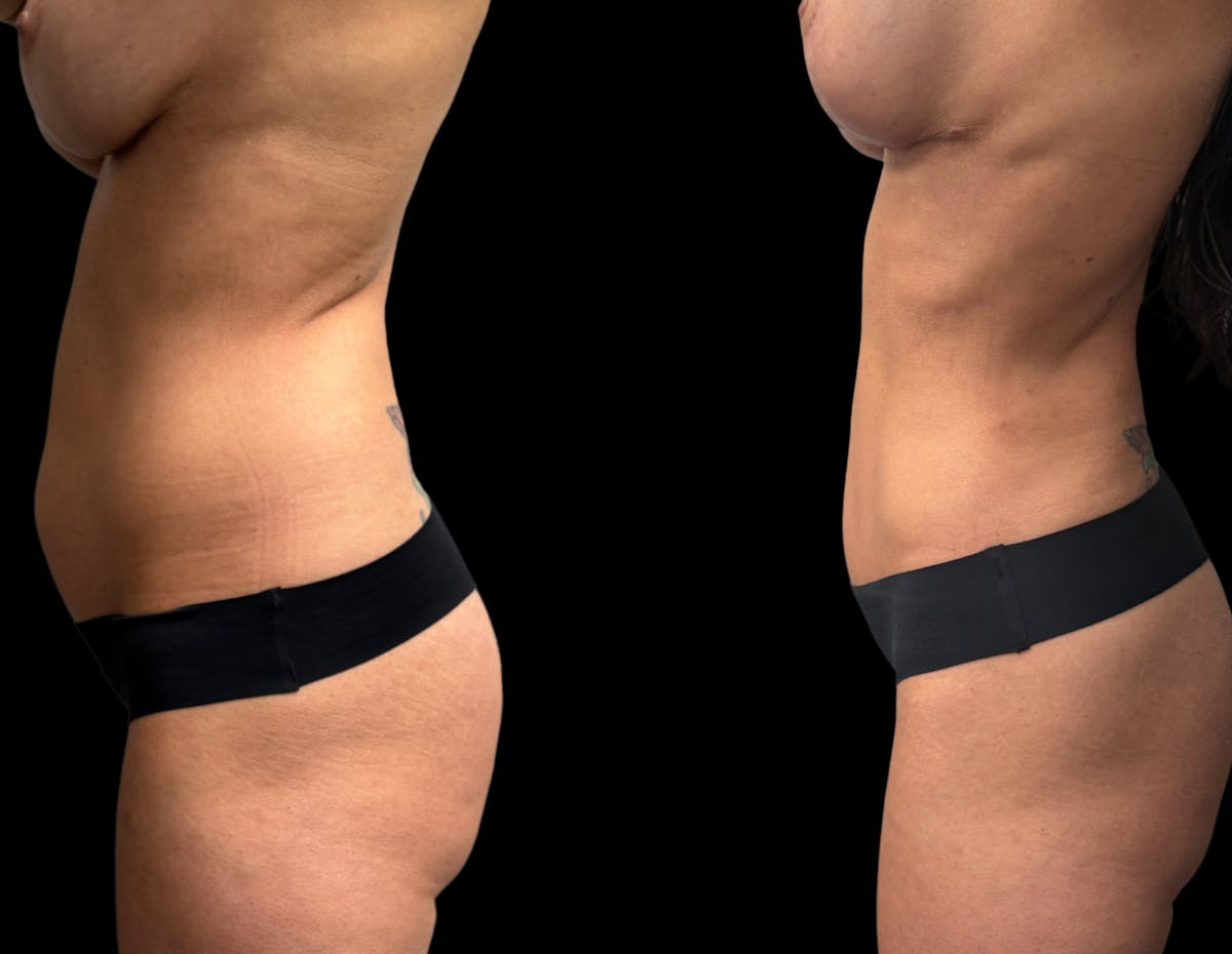 Mommy Makeover Before & After Gallery - Patient 136524 - Image 3