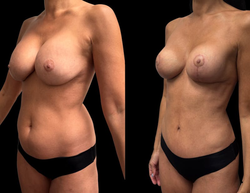 Mommy Makeover Before & After Gallery - Patient 136524 - Image 1