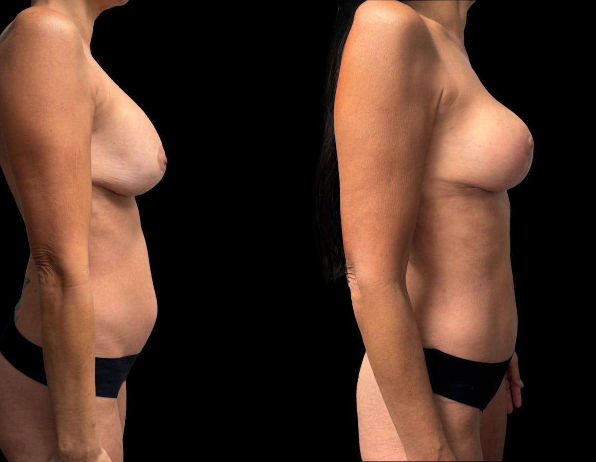 Mommy Makeover Before & After Gallery - Patient 136524 - Image 6