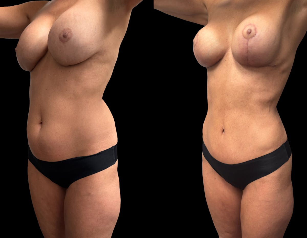 Mommy Makeover Before & After Gallery - Patient 136524 - Image 2