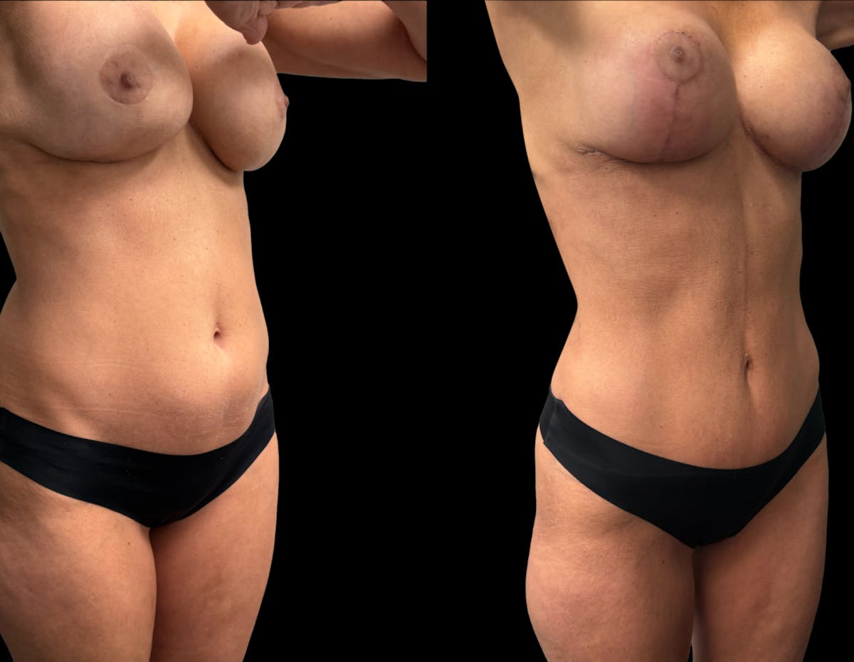 Mommy Makeover Before & After Gallery - Patient 136524 - Image 5