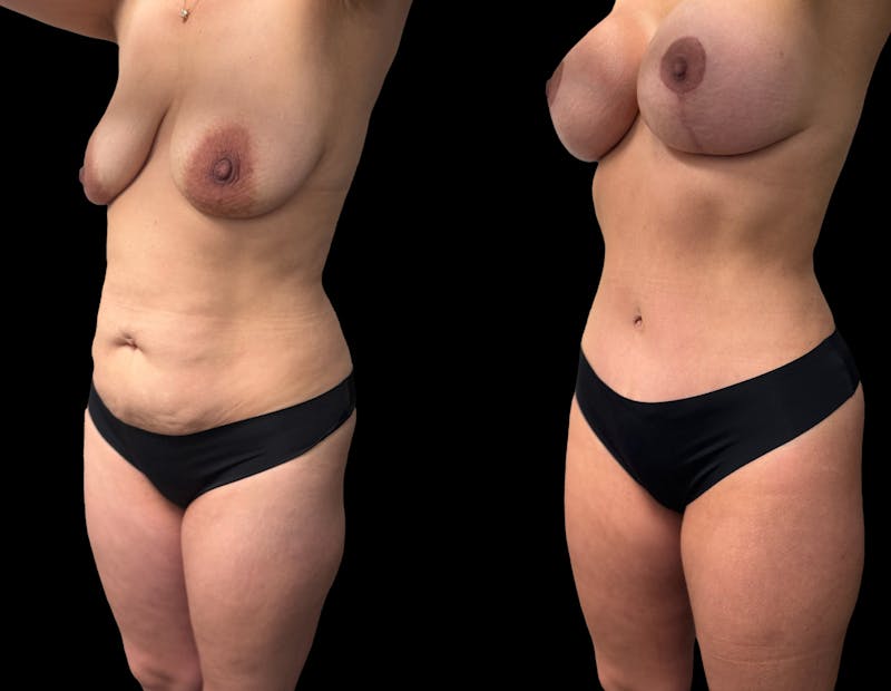 Mommy Makeover Before & After Gallery - Patient 210140 - Image 1