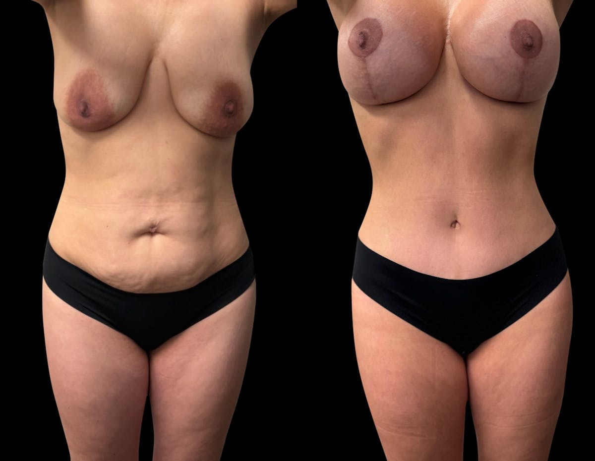 Mommy Makeover Before & After Gallery - Patient 210140 - Image 2