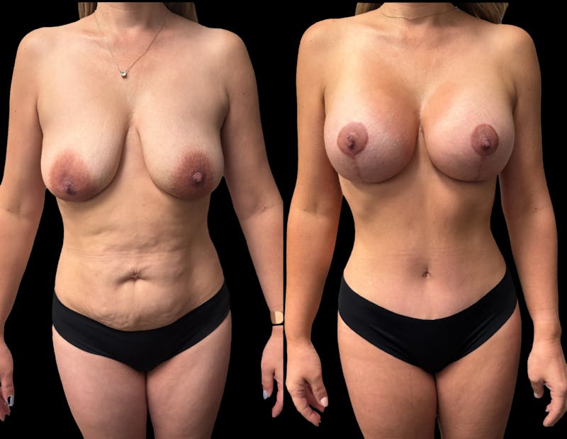 Mommy Makeover Before & After Gallery - Patient 210140 - Image 1