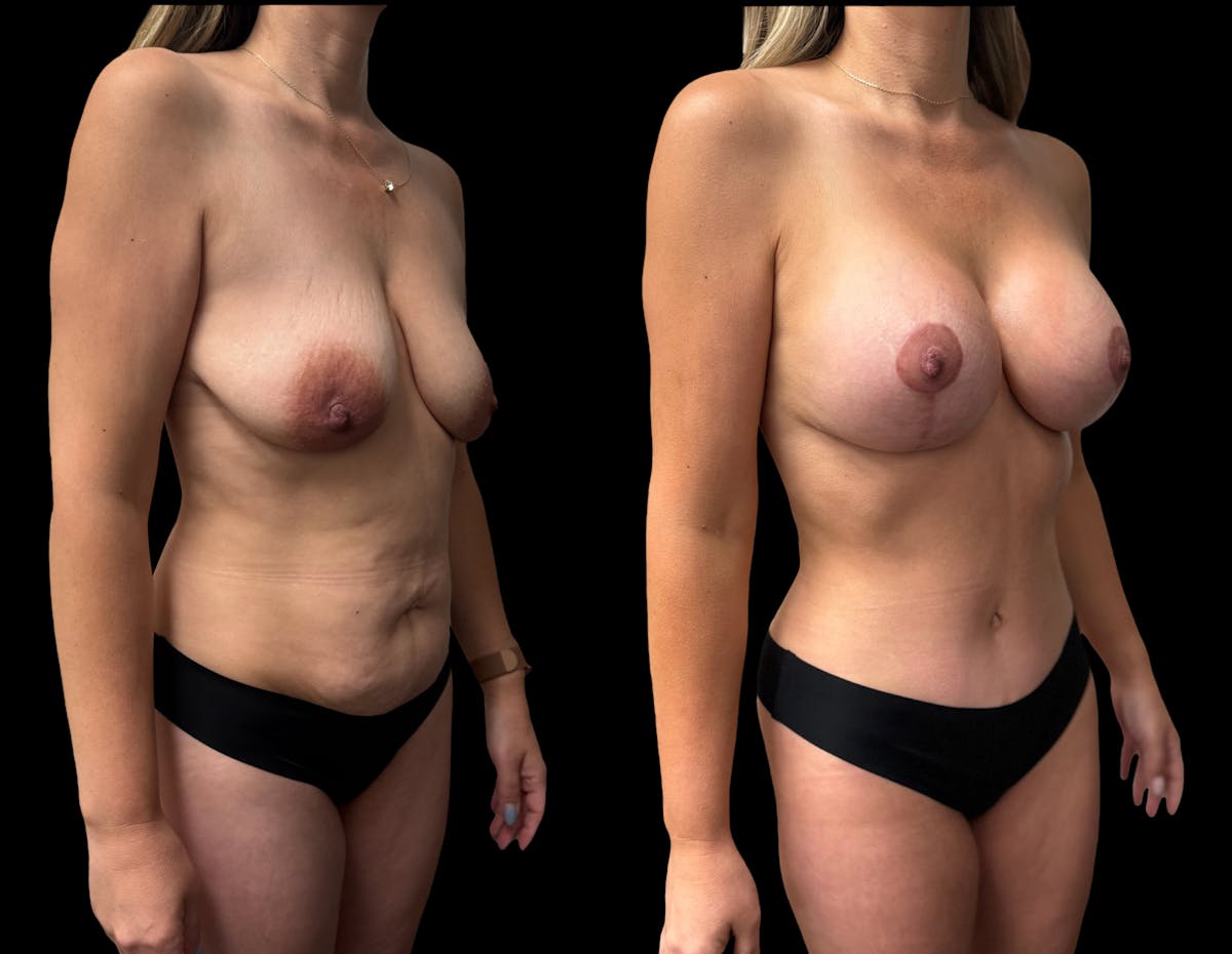 Mommy Makeover Before & After Gallery - Patient 210140 - Image 4