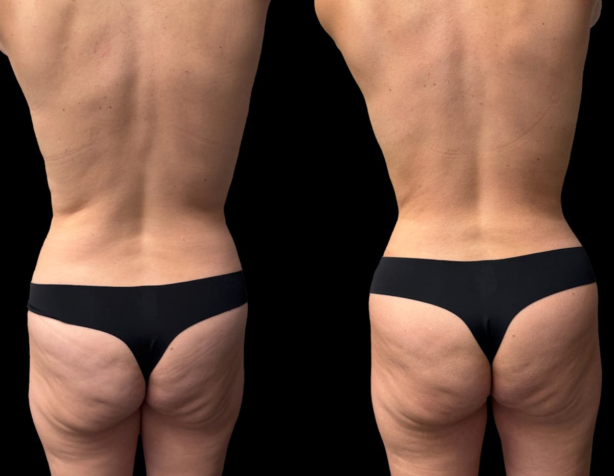 Mommy Makeover Before & After Gallery - Patient 210140 - Image 6