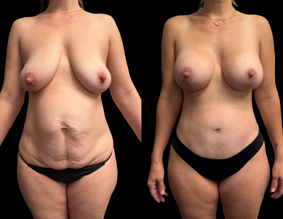 Mommy Makeover Before & After Gallery - Patient 336830 - Image 1