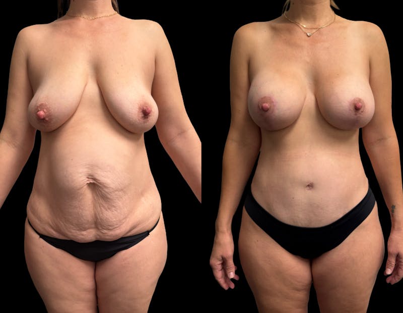 Mommy Makeover Before & After Gallery - Patient 336830 - Image 1