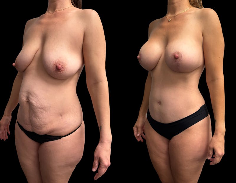 Mommy Makeover Before & After Gallery - Patient 336830 - Image 1