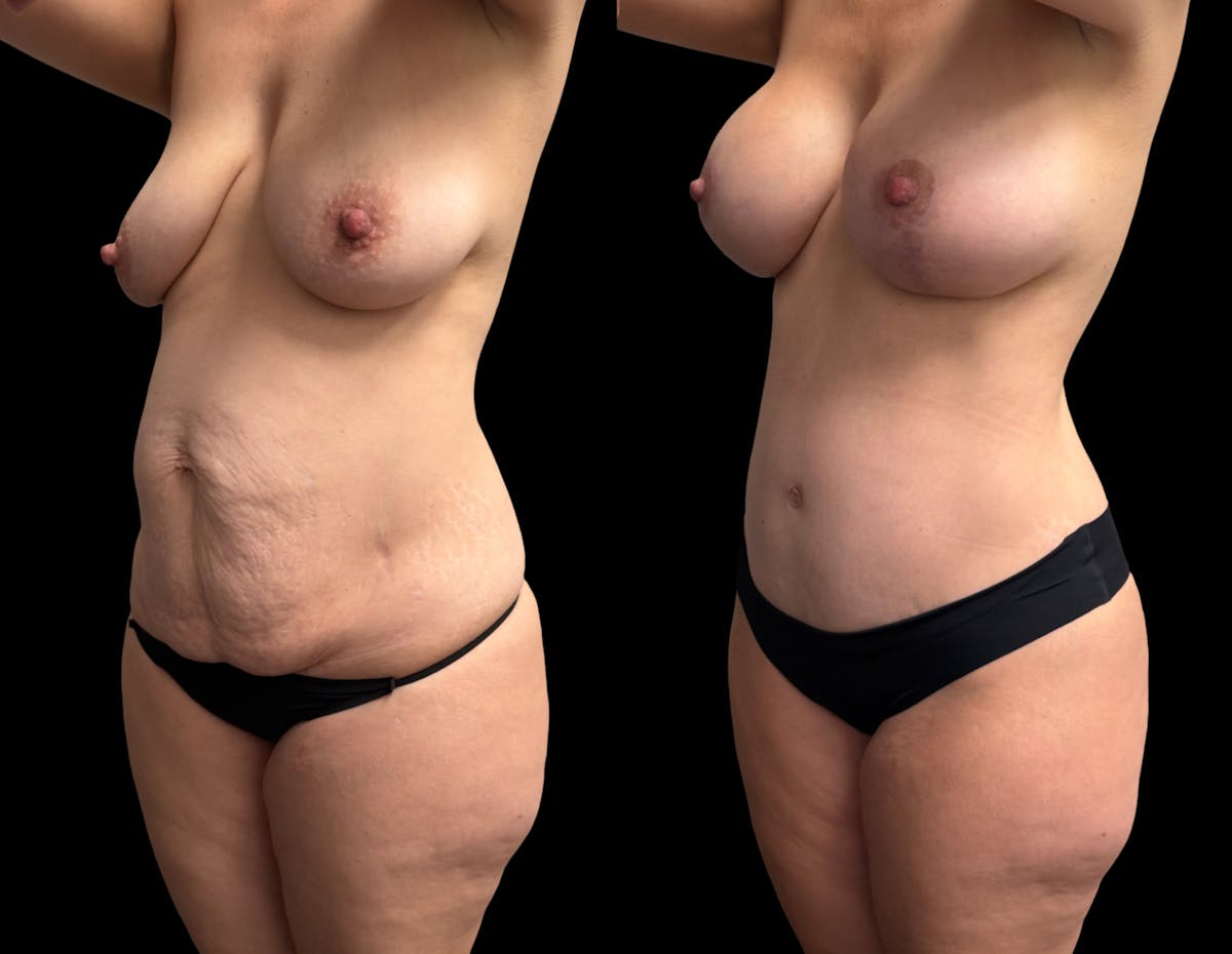 Mommy Makeover Before & After Gallery - Patient 336830 - Image 3