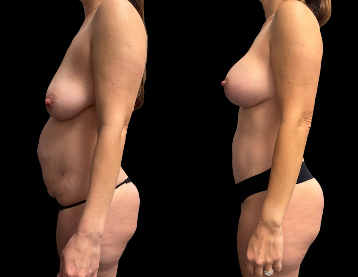 Mommy Makeover Before & After Gallery - Patient 336830 - Image 4