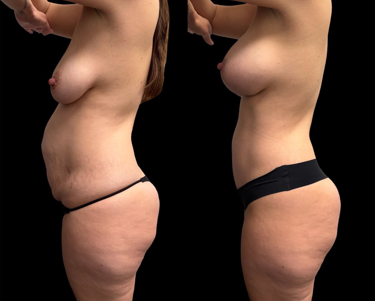 Mommy Makeover Before & After Gallery - Patient 336830 - Image 5