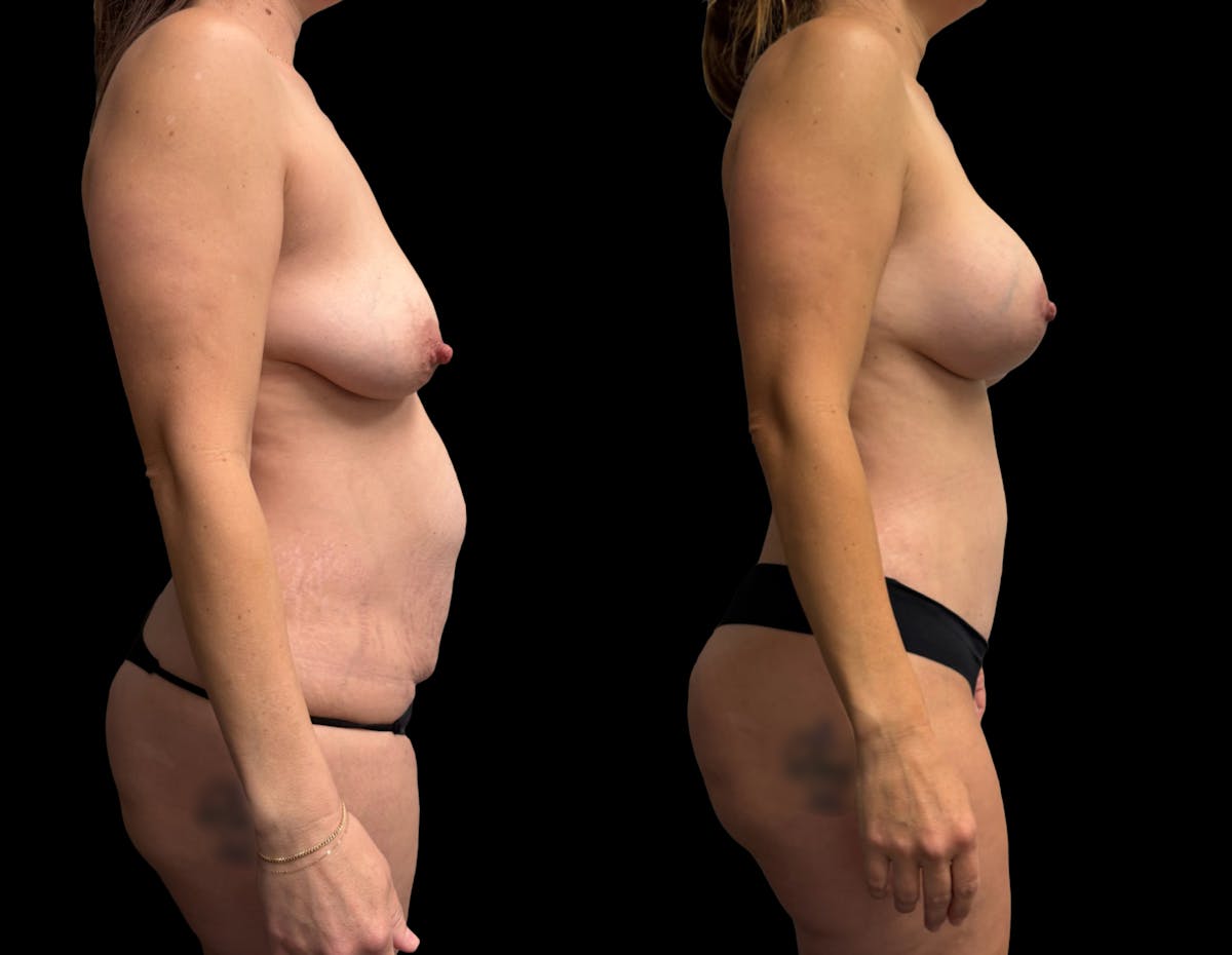 Mommy Makeover Before & After Gallery - Patient 336830 - Image 6