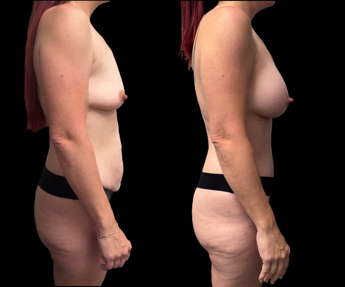 Mommy Makeover Before & After Gallery - Patient 202415 - Image 1