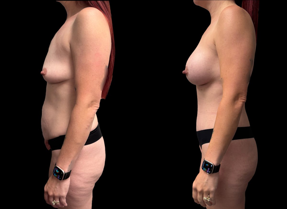 Mommy Makeover Before & After Gallery - Patient 202415 - Image 2