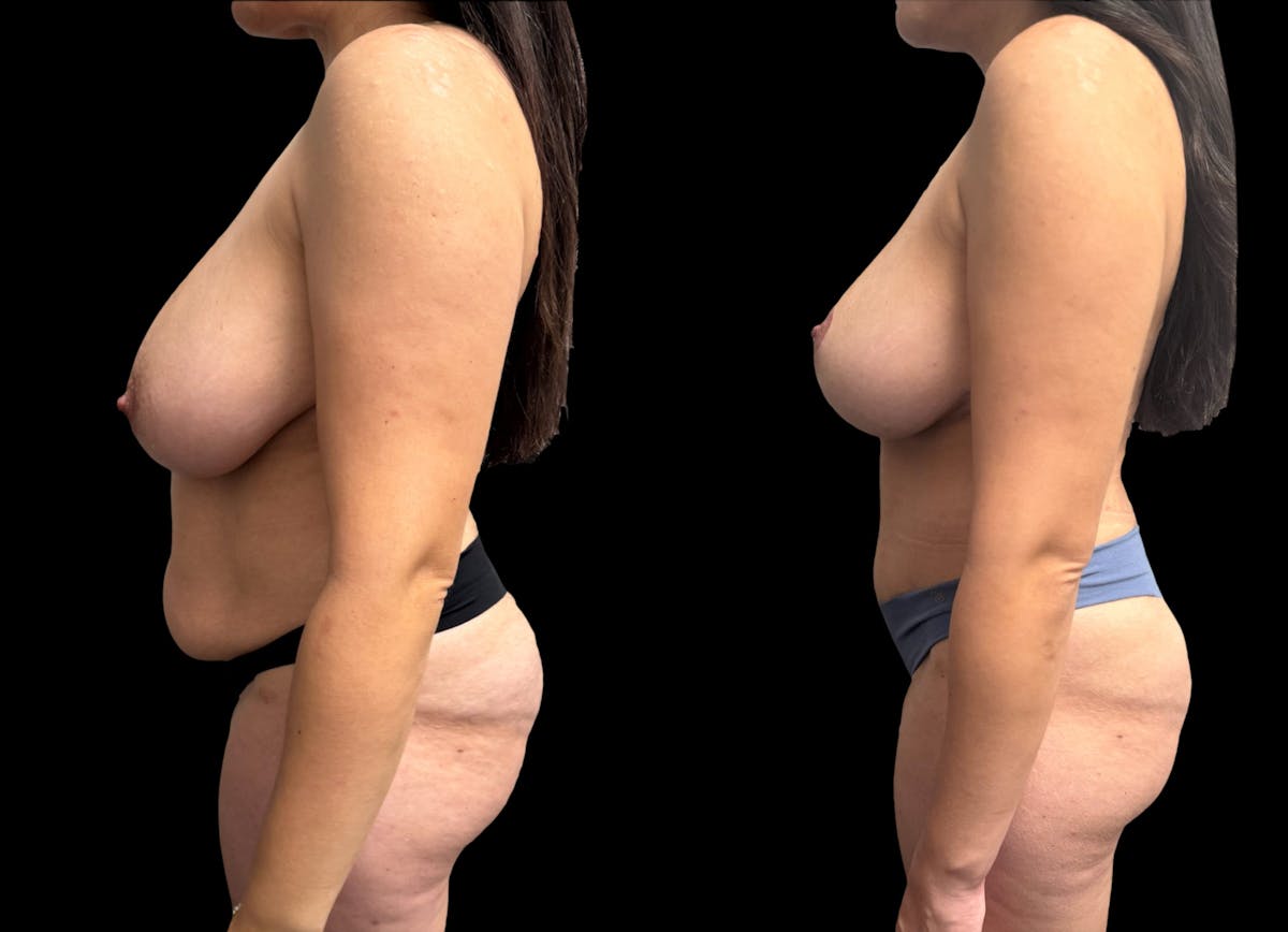 Mommy Makeover Before & After Gallery - Patient 105113 - Image 2