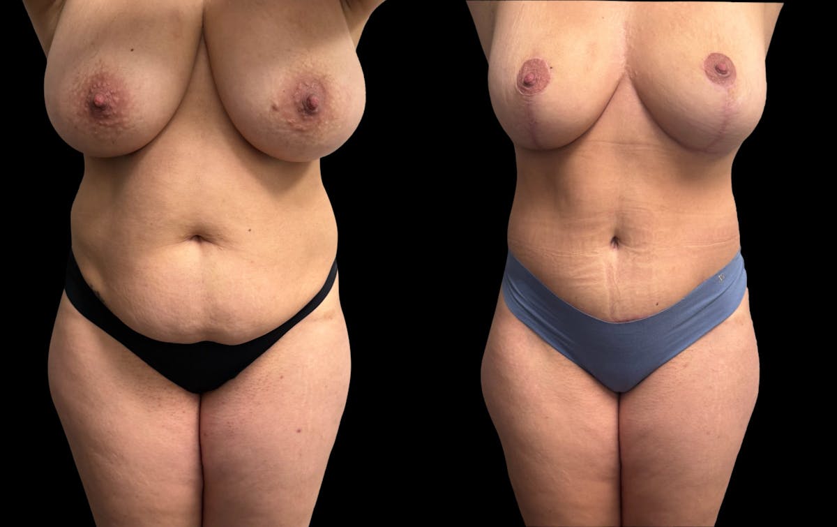 Mommy Makeover Before & After Gallery - Patient 105113 - Image 3