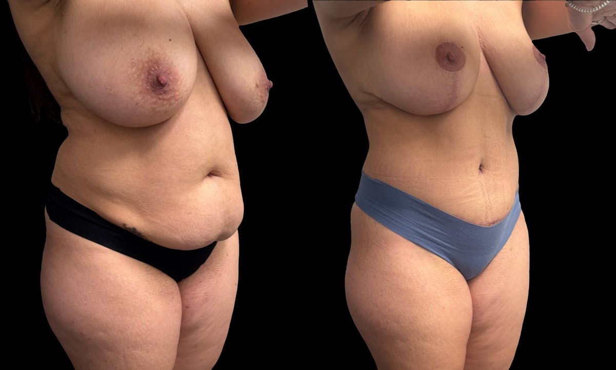 Mommy Makeover Before & After Gallery - Patient 105113 - Image 4