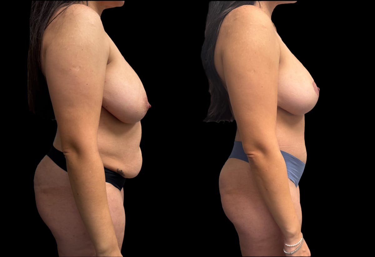 Mommy Makeover Before & After Gallery - Patient 105113 - Image 5