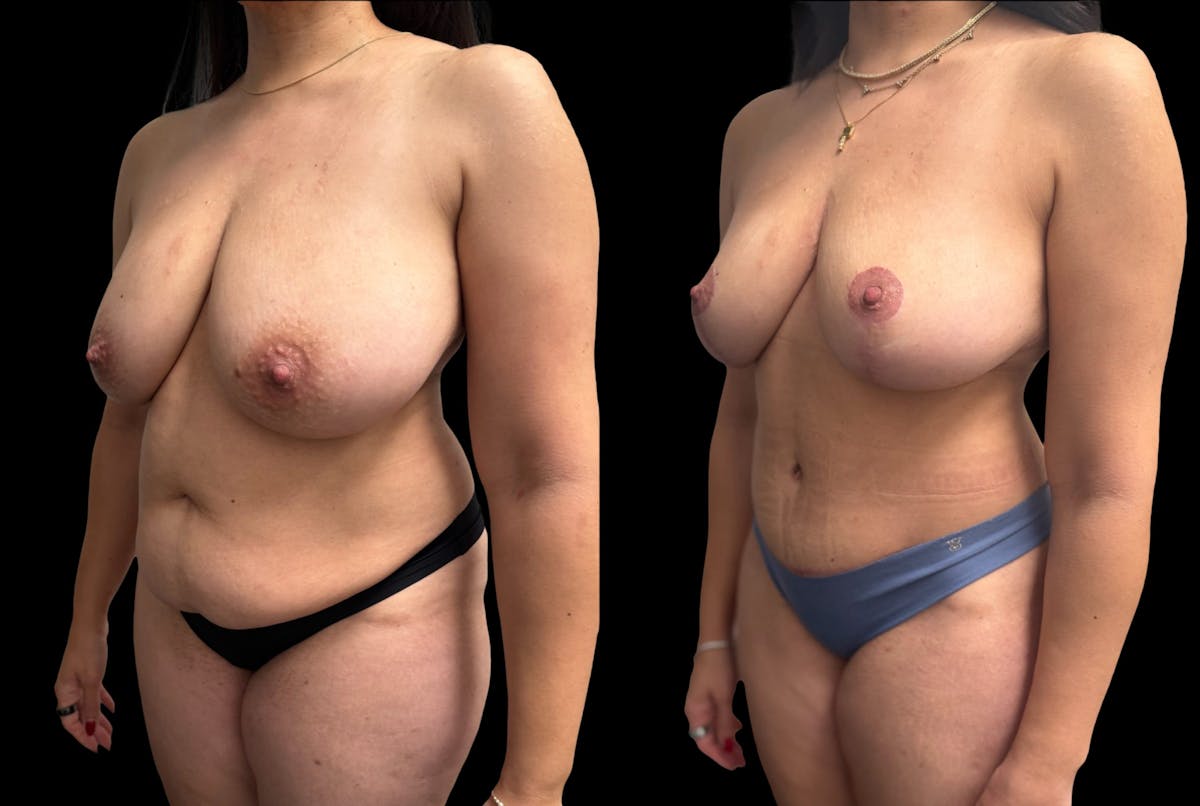 Mommy Makeover Before & After Gallery - Patient 105113 - Image 1