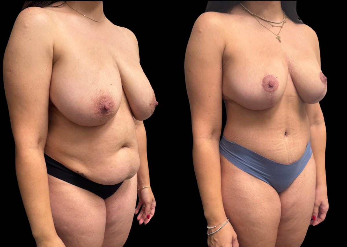 Mommy Makeover Before & After Gallery - Patient 105113 - Image 6