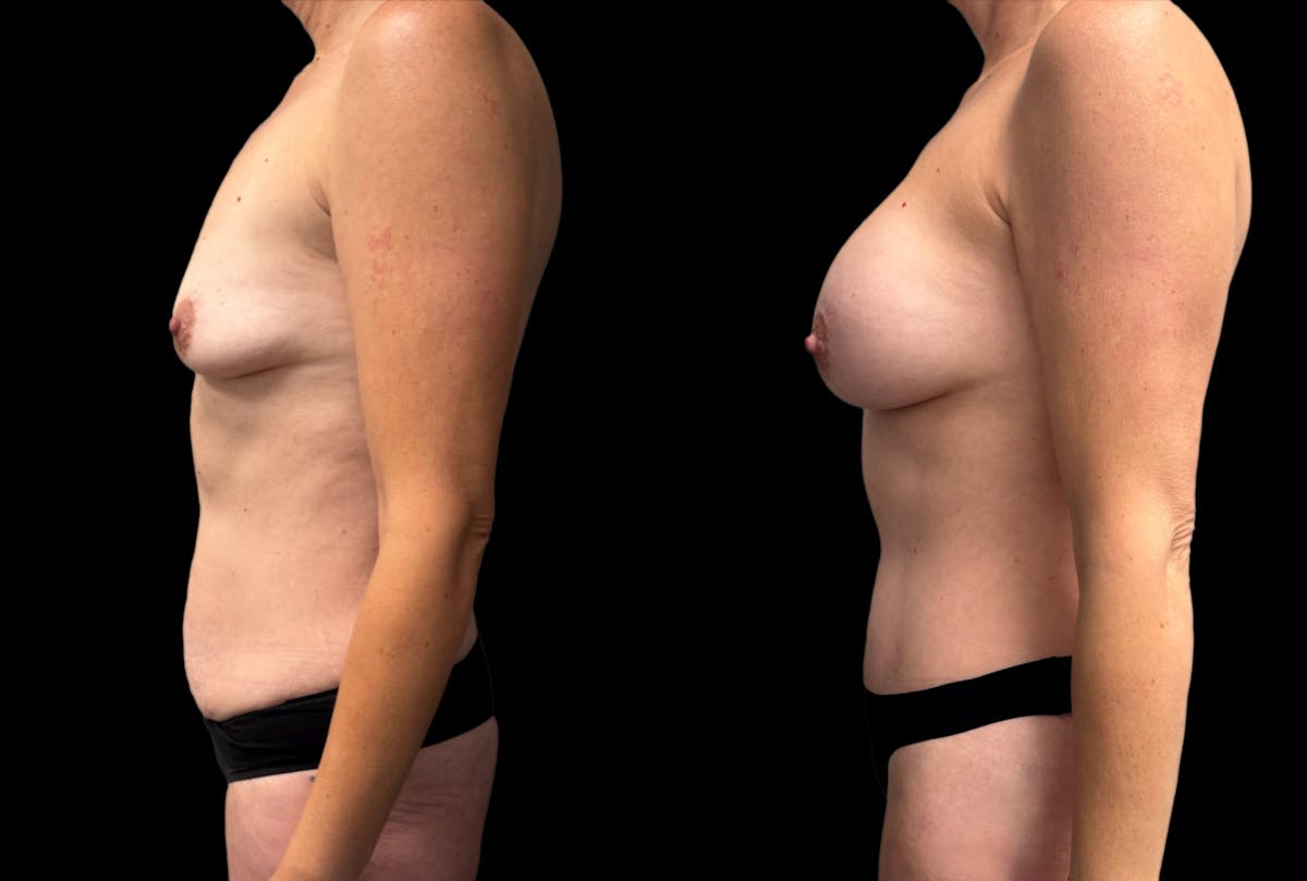 Mommy Makeover Before & After Gallery - Patient 125329 - Image 2