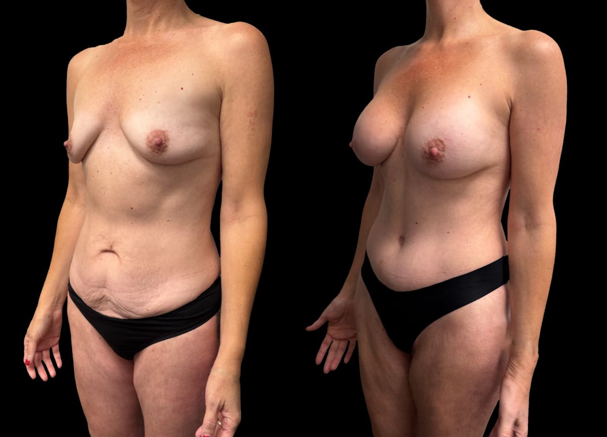 Mommy Makeover Before & After Gallery - Patient 125329 - Image 1