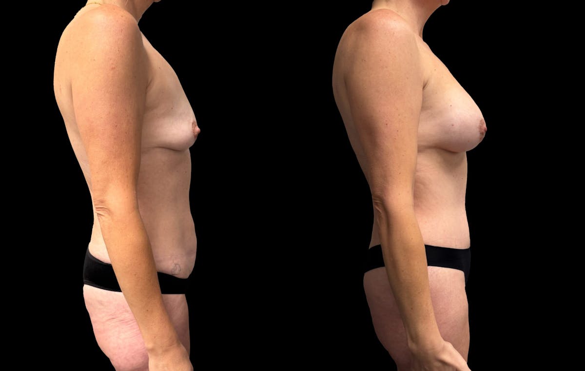 Mommy Makeover Before & After Gallery - Patient 125329 - Image 3