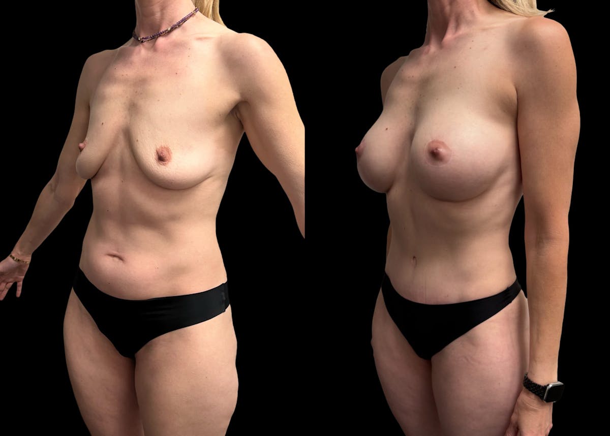 Mommy Makeover Before & After Gallery - Patient 218240 - Image 1