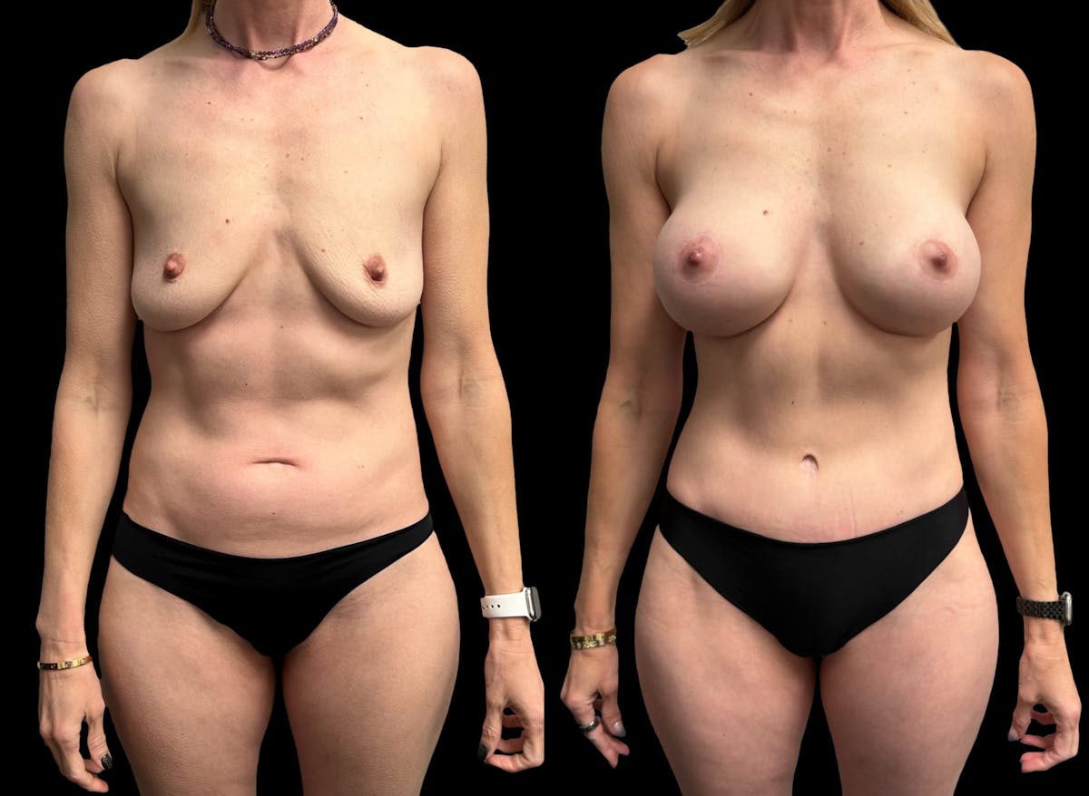 Mommy Makeover Before & After Gallery - Patient 218240 - Image 2