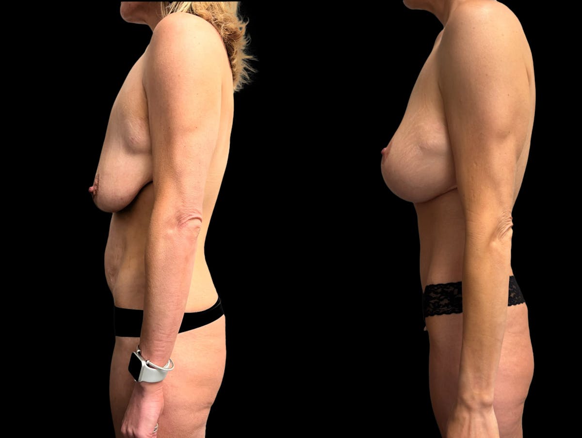 Mommy Makeover Before & After Gallery - Patient 355742 - Image 3